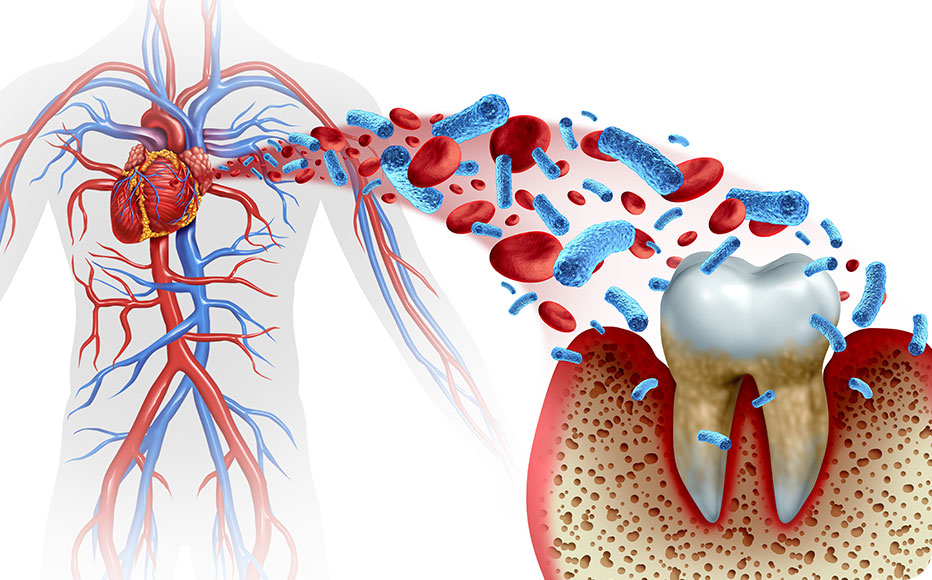 歯周病と全身疾患
