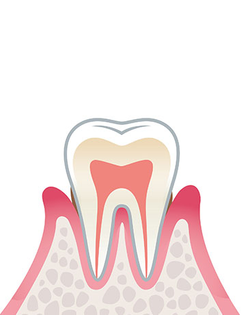 歯周炎（軽度）