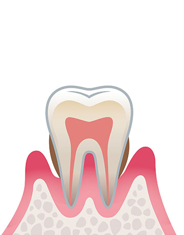 歯周炎（中度）
