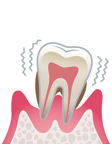 歯周炎（重度）